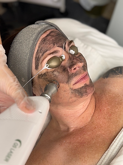 Carbon Laser Peel