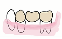 Implants1.png