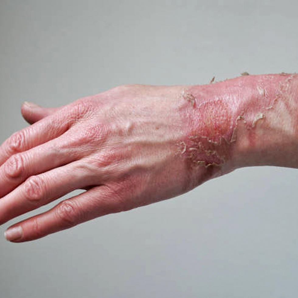 Thumbnail: Severely burned hand