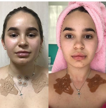 тейпирование