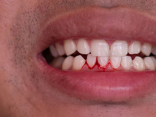 Why Are My Gums Bleeding? What Your Mouth Is Trying to Tell You