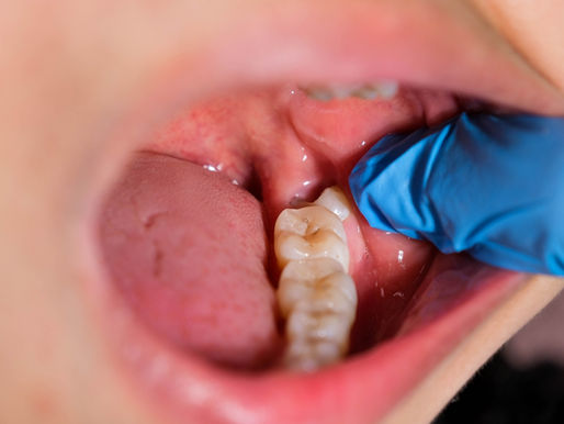 FACTS About Wisdom Teeth