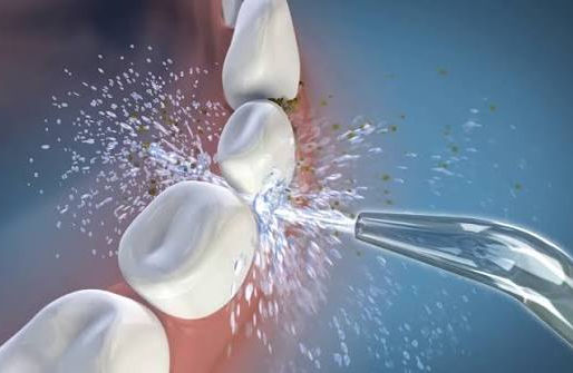 What is a Waterpik? The Science Behind Water Flossing