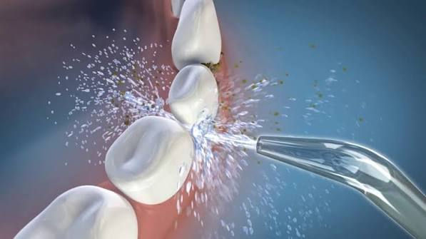 What is a Waterpik? The Science Behind Water Flossing