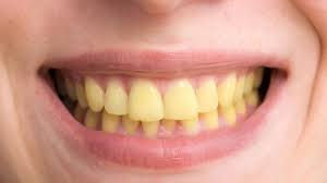 Why Do My Teeth Look So Yellow?