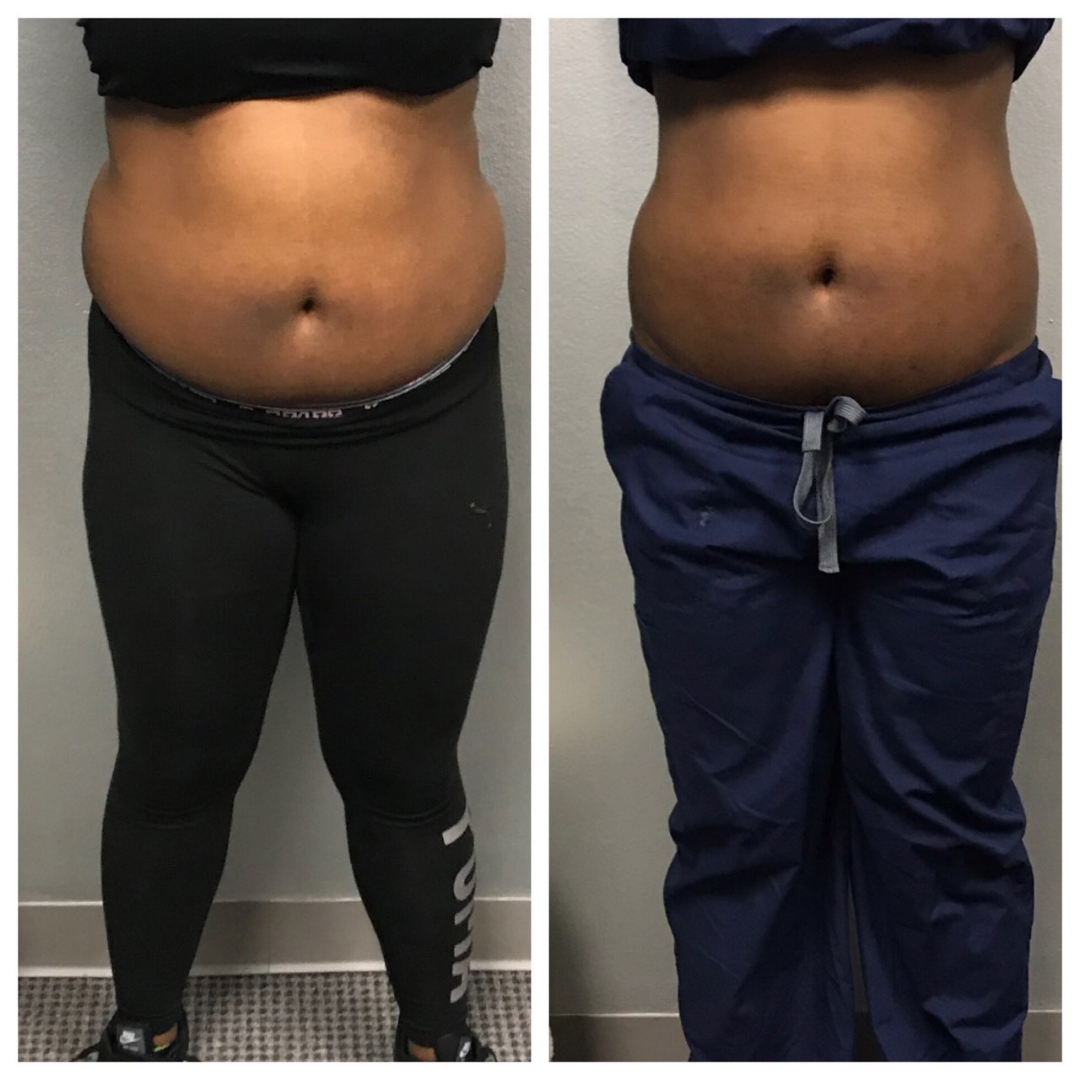 Gallery Slim Fit Beauty Body Contouring in Houston and Humble, Tx