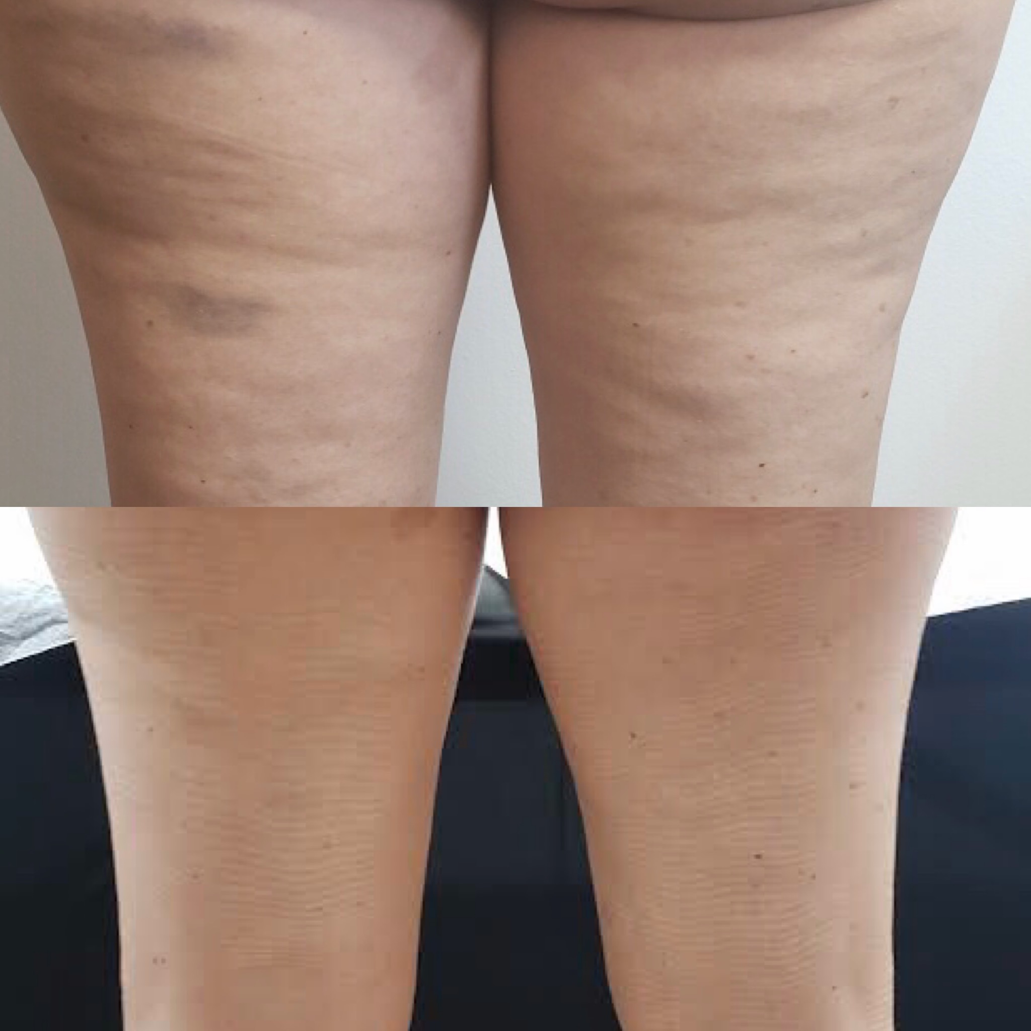 Gallery Slim Fit Beauty Body Contouring in Houston and Humble, Tx