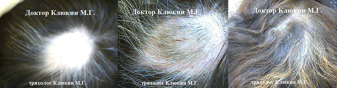 трихолог спб, хороший трихолог спб, лечение волос, трихолог клюкин, горквд, клиника лечения волос