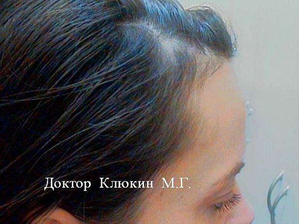 трихолог спб, хороший трихолог спб, лечение волос, трихолог клюкин, горквд