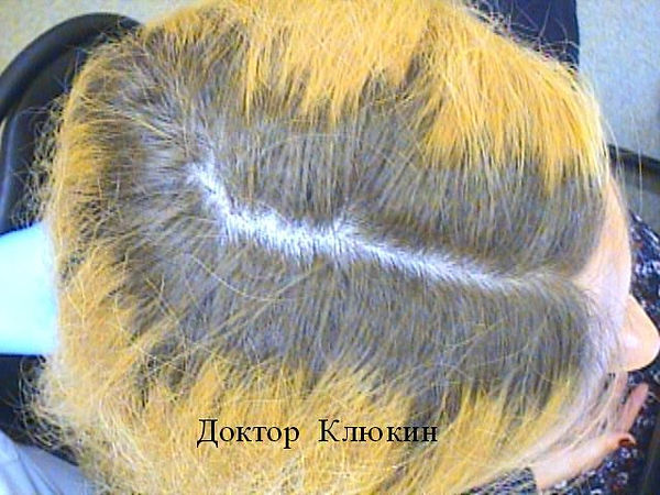 трихолог спб, трихолог, хороший трихолог, лечение волос спб, трихолог клюкин