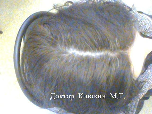 трихолог спб, трихолог, хороший трихолог, лечение волос спб, трихолог клюкин