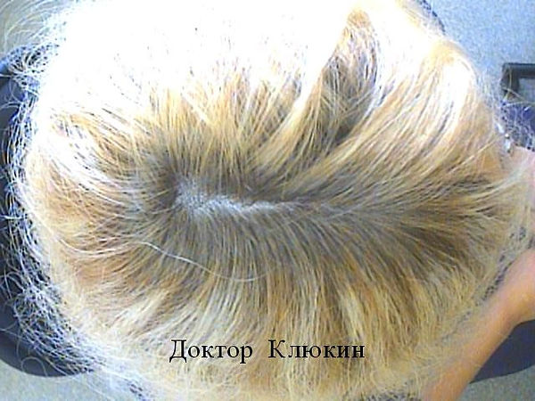трихолог спб, трихолог, хороший трихолог, лечение волос спб, трихолог клюкин