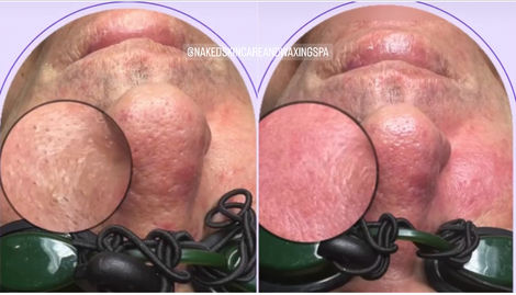 Anti-Acne Detox Facial