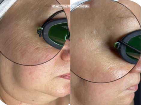 DMK Muscle Banding Facial (Non-Surgical Facelift)