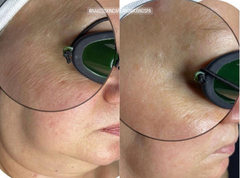 DMK Muscle Banding Facial (Non-Surgical Facelift)