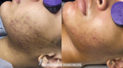 Pseudofolliculitis Barbae Facial