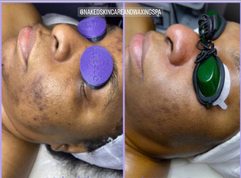 Acne Academy Treatment (initial)
