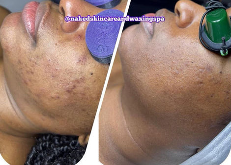 Acne Academy Treatment (initial)