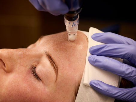 Microneedling device touching forehead of patient