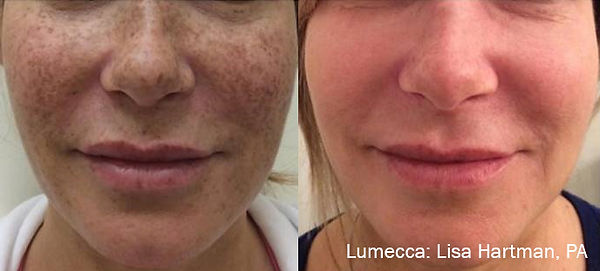 Lumecca before and after pictures showing great results