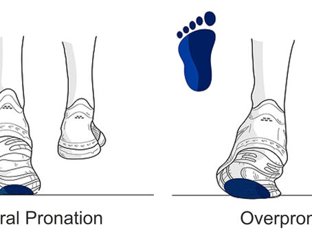Overpronated Feet