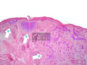 Benefício da Cirurgia Micrográfica de Mohs para o tratamento do Carcinoma Basocelular na face