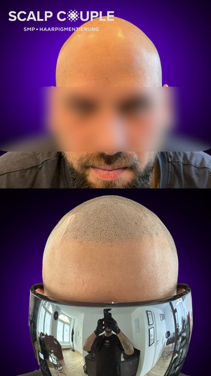 Haarpigmentierung für Männer im Schwarzwald