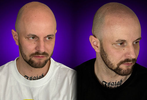 Vorher-Nachher einer Haarpigmentierung für Männer