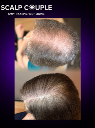 Vorher-nachher Vergleich einer SMP Haarpigmentierung