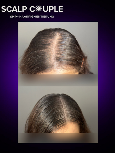 Vorher-Nachher-Bild von SMP zur Scheitelverdichtung