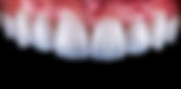 Non-Prep Veneers