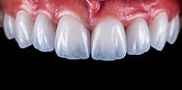 Non Prep Veneers Basel – minimalinvasive Zahnkorrektur