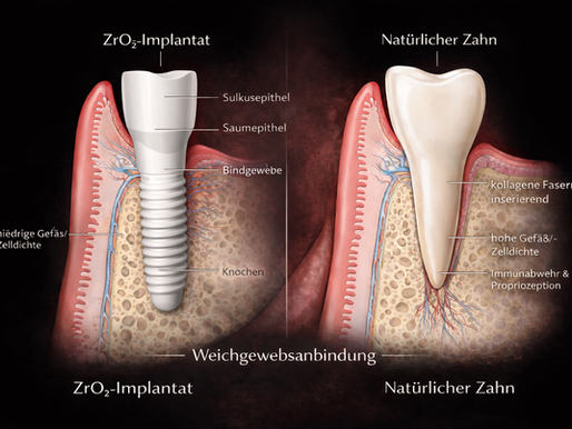 Implantate in Basel