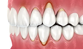 Zahnfleischrückgang, auch als Gingivalrezession bezeichnet, ist ein Zustand, bei dem das Zahnfleisch sich zurückzieht und den Zahnwurzeln mehr freiliegt. Dieser Zustand kann verschiedene Komplikationen und Probleme verursachen, darunter:
- Empfindlichkeit der Zähne: Wenn das Zahnfleisch zurückweicht und die Wurzeln der Zähne freigelegt werden, können die Zähne empfindlicher auf heiße, kalte, süße oder saure Nahrungsmittel und Getränke reagieren.
- Zahnfleischentzündung: Die freiliegenden Zahnwurzeln sind anfälliger für Zahnfleischentzündungen (Gingivitis) und Zahnfleischerkrankungen (Parodontitis). Dies kann zu Rötung, Schwellung und Blutungen des Zahnfleisches führen.
- Kosmetische Probleme: Zahnfleischrückgang kann zu ästhetischen Problemen führen, da die Zähne länger erscheinen und der Lächelnauftritt beeinträchtigt sein kann.
- Zahnschäden und Lockerheit: Freiliegende Zahnwurzeln sind anfälliger für mechanische Schäden und Abnutzung, was zu Zahnbeschädigungen und -lockerheit führen kann.
- Veränderungen der Zahnstellung und des Bisses: Langfristiger Zahnfleischrückgang kann Veränderungen in der Zahnstellung und im Biss verursachen, was zu funktionellen Problemen beim Kauen führen kann.
- Verlust des Zahnhalteapparates: Bei fortschreitendem Zahnfleischrückgang kann der Zahnhalteapparat, einschließlich des Kieferknochens, geschädigt werden, was langfristige Folgen für die Mundgesundheit haben kann.
- Verlust von Zähnen: In schweren Fällen kann Zahnfleischrückgang zur Lockerheit und zum Verlust von Zähnen führen.
Die Behandlung von Zahnfleischrückgang hängt von der Ursache und dem Schweregrad des Problems ab. Die Verwendung von speziellen Zahnbürsten und -techniken, desensibilisierenden Zahnpasten, zahnärztlichen Fluoridbehandlungen und professionellen Zahnreinigungen können dazu beitragen, die Empfindlichkeit zu reduzieren und die Zahnfleischgesundheit zu verbessern. Bei schwerwiegenderen Fällen kann eine Zahnfleischtransplantation oder andere chirurgische Verfahren erforderlich sein, um das Zahnfleisch wiederherzustellen und die Komplikationen zu minimieren.
Die regelmäßige zahnärztliche Untersuchung und professionelle Mundhygiene ist entscheidend, um Zahnfleischprobleme frühzeitig zu erkennen und zu behandeln, und kann dazu beitragen, Komplikationen zu verhindern und die Mundgesundheit zu erhalten.