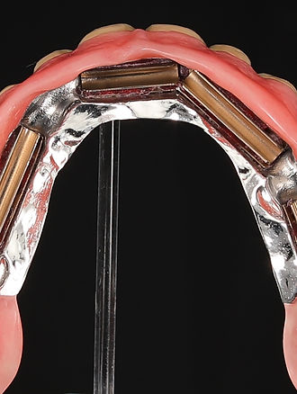 Stegprothese in Basel