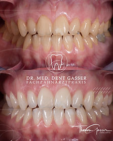 Bleaching in Basel - Vorher Nachher Bild