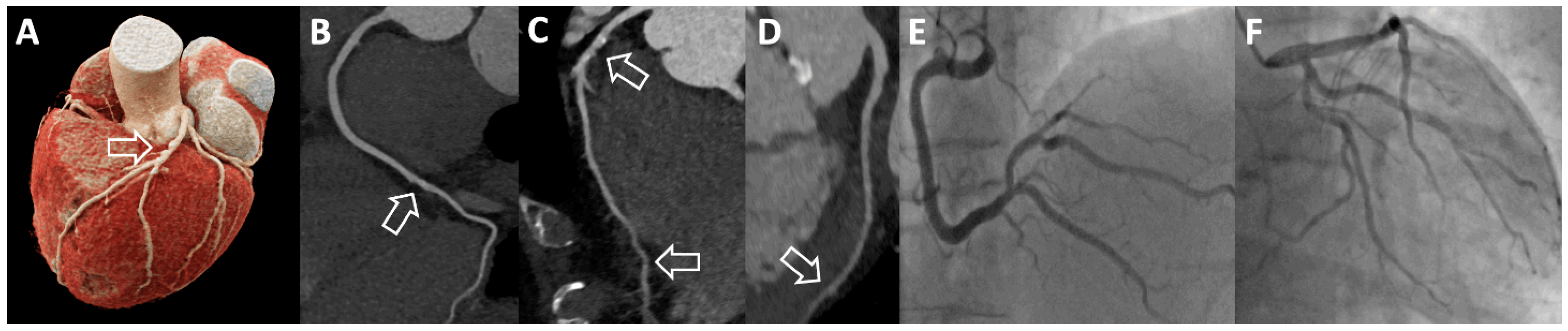 CT Evaluation for TAVI