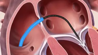 Navigating the Dynamic Terrain of Mitral Valve Interventions: A Journey of Innovation and Expertise