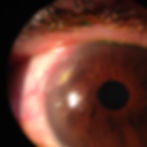 ULCERA CORNEAL DR MARCO HERNANDEZ OFTALMOLOGO
