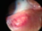 BLEFARITIS DR MARCO HERNANDEZ OFTALMOLOGO