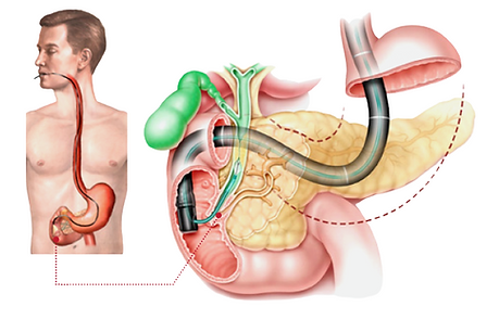 Ilustração do procedimento colangiopancreatografia retrógrada endoscópica - CPRE
