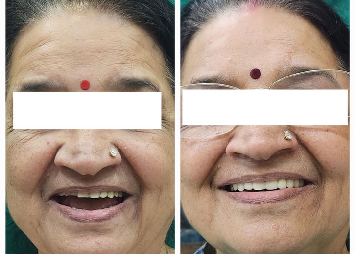 full mouth rehabilitation