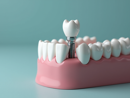 Benefits of Dental Implants: Why They Are the Best Choice for Your Smile