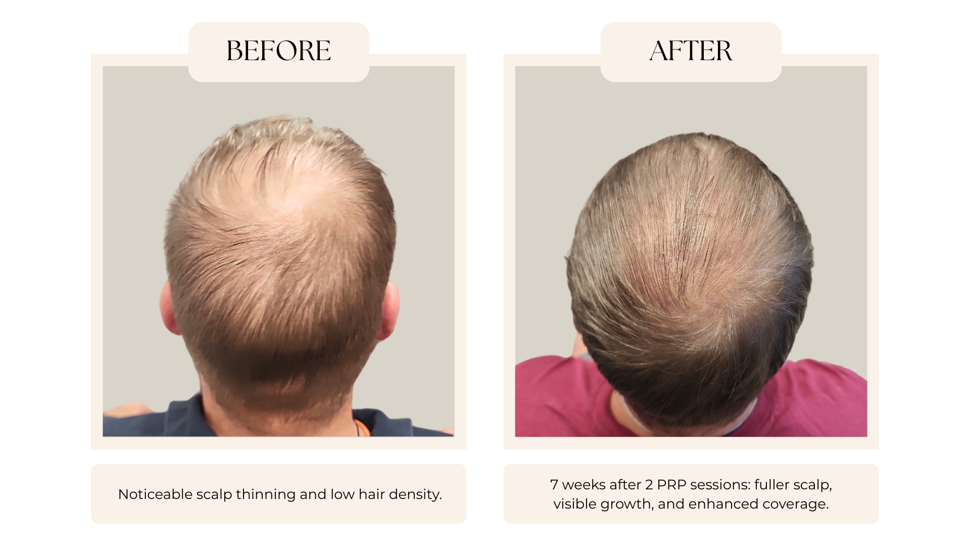 PRP with Microneedling.png