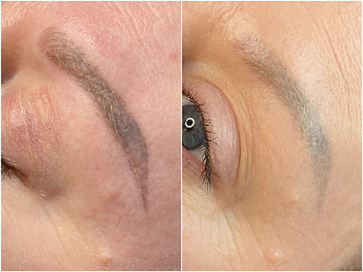 Botched Ink Saline tattoo removals lightening before and after