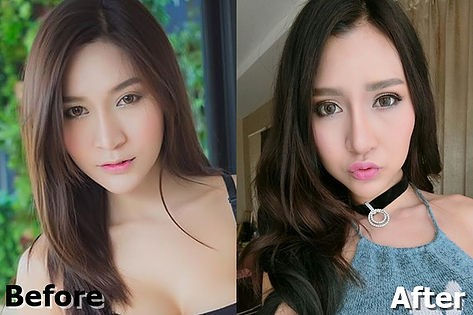 Double Eyelid Surgery