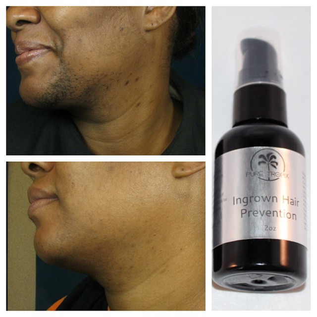 5 Steps To Banish Ingrown Hairs