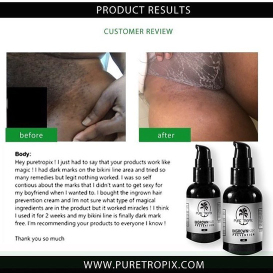 Ingrown Hair Down There Bikini Area Ingrown