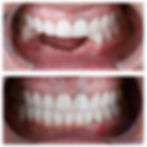 izmir implant destekli zirkon köprü