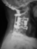 CervicalCorpectomy